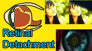 Retinal detachment symptoms causes and treatment [upl. by Elsi]