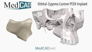 OrbitalZygoma Custom PEEK Implant  Render [upl. by Lias]