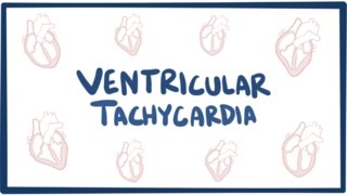 Ventricular tachycardia VT  causes symptoms diagnosis treatment amp pathology [upl. by Anicart]