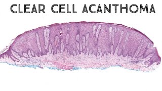 Clear cell acanthoma pathology dermpath dermatology dermatopathology [upl. by Ailaroc]