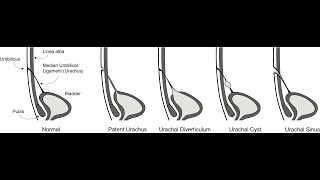 Results of Patent urachus Urachal cyst urachal sinus Diverticulum urachal fistula [upl. by Reisch644]