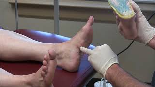 Painful Plantar Fibromas in Feet [upl. by Attevaj]