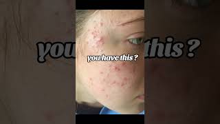 acne spot treatmentbrevoxyl cream usebenzoyl peroxide for acne how to treat overnight pimples [upl. by Adolf]