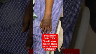 Blunt Injury WristTFCC TearExtensor Tendon Edema Dr Sai Chandra 9573517107 [upl. by Ynaoj]