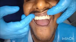 Crown cutting of Front Teeth And Cap Fixing Final look [upl. by Lainey]