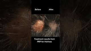 Prp hair treatment prp prphair prphairtreatment prphairrestoration prptherapy [upl. by Pomcroy]