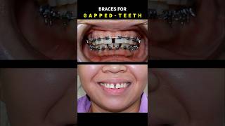 BRACES FOR GAPPED TEETH 32 MONTHS DURATION braces orthodontist dentist [upl. by Renado]