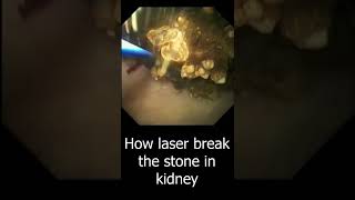 How the Laser Break Kidney stone  Laser Lithotripsy [upl. by Adas867]