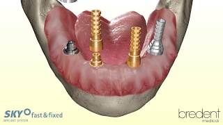 SKY fast amp fixed implant system  3D animation [upl. by Vivl]