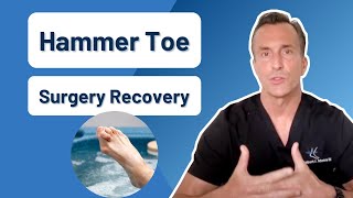 How Long Is Recovery From Hammer Toe Surgery [upl. by Talie619]