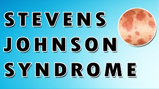 Stevens Johnson Syndrome Symptoms Treatment and Causes [upl. by Lenoel952]