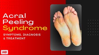 Acral Peeling Syndrome Symptoms Diagnosis and Treatment [upl. by Anna-Maria]