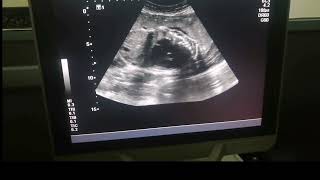 Cardiomegaly at 19th week of Gestation on Routine OBS Scan [upl. by Drue]