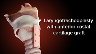 Medical Animation Anterior Cricoid Split  Cincinnati Childrens [upl. by Atterual184]