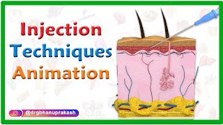 Injection Techniques Animation  Intradermal Intramuscular Subcutaneous and Z track [upl. by Alliuqa]