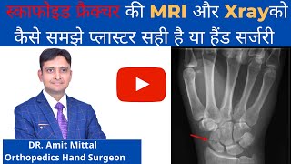 Scaphoid Fracture in hindi  टूटी ही कलाई की हड्डी के XRAY और MRI को कैसे समझे  स्केफोइड फ्रैक्चर [upl. by Areema73]