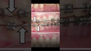 Dentist Reveal the Common Problems During Braces Treatment [upl. by Hayashi]