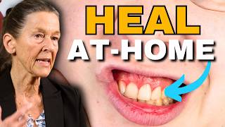 Quickly Heal Gingivitis amp Bleeding Gums Naturally at Home [upl. by Afesoj]