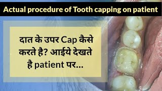 आईए देखते है Tooth Capping कैसे करते है l Tooth Capping Procedure on patient [upl. by Dario506]