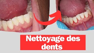 Le nettoyage dentaire aux ultrasons estil efficace [upl. by Cynarra179]