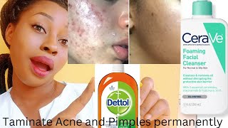 How to clear Acne and pimples very fast with Dettol and CeraVe foaming cleanseracneglassskin [upl. by Arty]