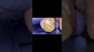 Extra thick onychomycosis nail trimmingsatisfying [upl. by Coleen252]