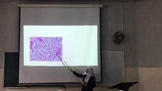 CNSpathologylecture9part2oligodendroglioma [upl. by Nnylesor]