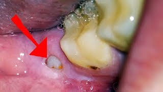 Wisdom Tooth Pain What you NEED to Know Oral Sedation Home Remedies and What to Expect [upl. by Ramas]