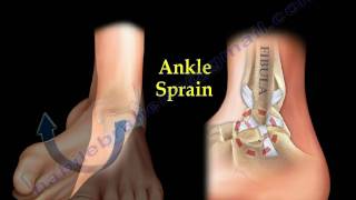 Ankle Pain ankle ligaments sprain  Everything You Need To Know  Dr Nabil Ebraheim [upl. by Lillywhite]