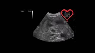 Pyloric Stenosis Ultrasound [upl. by Johnette]