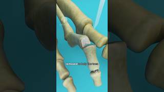 What is Hammer Toe and How to Fix It shorts viralvideo  Creativelearning3d [upl. by Ailecnarf]