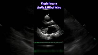 Infective Endocarditis invloving Mitral and Aortic Valve heart shorts echocardiography [upl. by Vernice19]