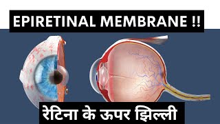 Retina पर झिल्ली  क्या है Epiretinal Membrane ERM [upl. by Notlef]