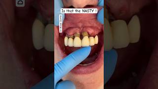 Is that a NASTY  tooth vlog [upl. by Kendre]