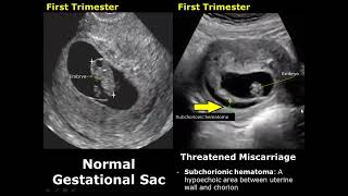 Uterus Ultrasound Normal Pregnancy Vs Miscarriage Image Appearances  Intrauterine Pregnancy USG [upl. by Notsnorb765]