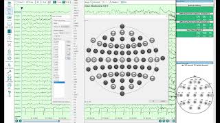 Custom average reference montages in Persyst with sub temporal electrodes [upl. by Notrem]