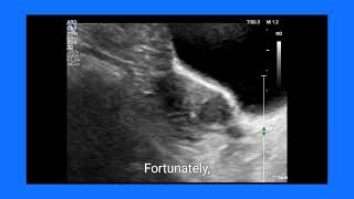 Fibroid vs LSCS Scar Dehiscence How Ultrasound and Doppler Make the Diagnosis [upl. by Anahsed533]