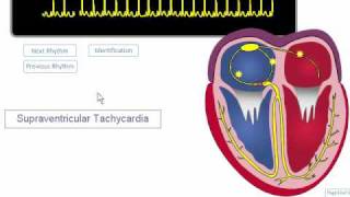 ECG Rhythm Review SVT Atrial Fibrillation Atrial Flutter [upl. by Inamik]