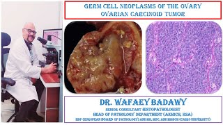 GERM CELL NEOPLASMS OF THE OVARY OVARIAN CARCINOID TUMOR BY DR WAFAEY BADAWY [upl. by Nysa]