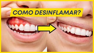 COMO TRATAR A GENGIVA INFLAMADA DO PACIENTE [upl. by Holihs]