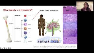 Progress in understanding and treating nonHodgkin lymphoma NHL [upl. by Lexine]