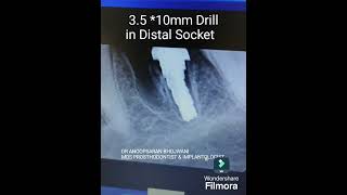 Extraction and Immediate Implant Placement in mandibular first molar 36 bone graft amp sutures [upl. by Alin]