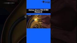 Kidney stone laser treatment  Retrograde Intrarenal Surgery  Rirs shorts [upl. by Nalyt]