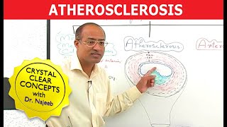 Atherosclerosis  Pathophysiology [upl. by Secor]