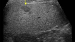 Hepatic mass Splenomegaly Ascites Hepatomegaly Hydatid cyst Hepatic Hydatid cyst [upl. by Nirat]