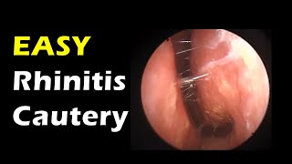 Very Easy Rhinitis treatment simple cautery [upl. by Ynogoham]