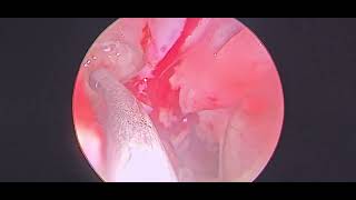 Polyp arising from margin of maxillary sinus opening  Dr Hitesh Patel [upl. by Czarra20]