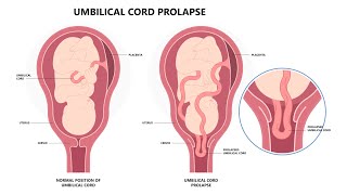 Surviving Umbilical Cord Prolapse And HIE [upl. by Liz]