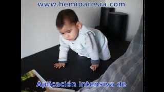 Hemiparesia Infantil  terapia Bobath [upl. by Philbin]