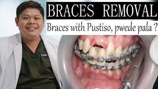 Braces with Pustiso pwede ba TARA at ALAMIN  BRACES REMOVAL  Doc Noy [upl. by Ahsiekrats]